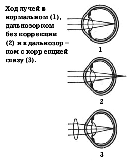 Схема хода лучей в глазном яблоке при дальнозоркости